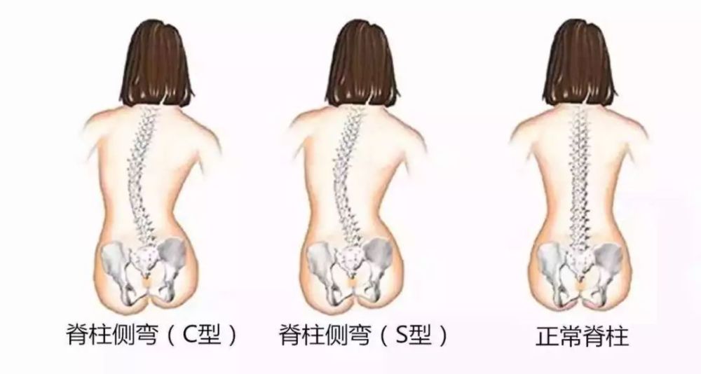 最新脊柱側(cè)彎治療方法及其奇妙之旅