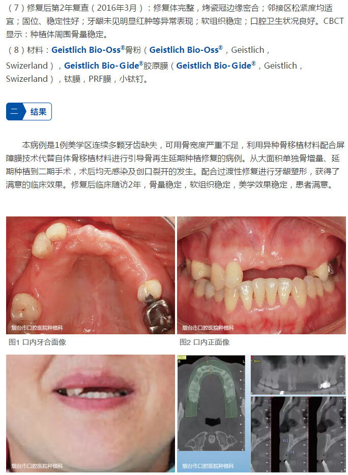 最新再生牙技術，笑迎人生，勇敢追求學習與變化的力量
